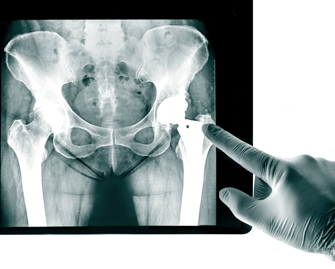 Hip Reconstruction and Replacement Surgery, Conditions & Treatments