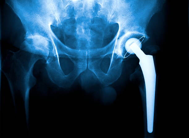 What is a Total Hip Replacement? - Orthoanswer